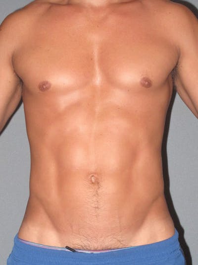 Abdominal Etching Before & After Gallery - Patient 20913141 - Image 2