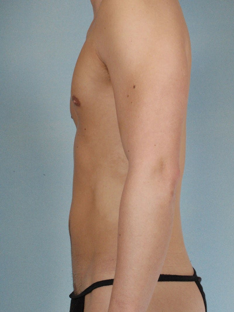 Abdominal Etching Before & After Gallery - Patient 20913141 - Image 5