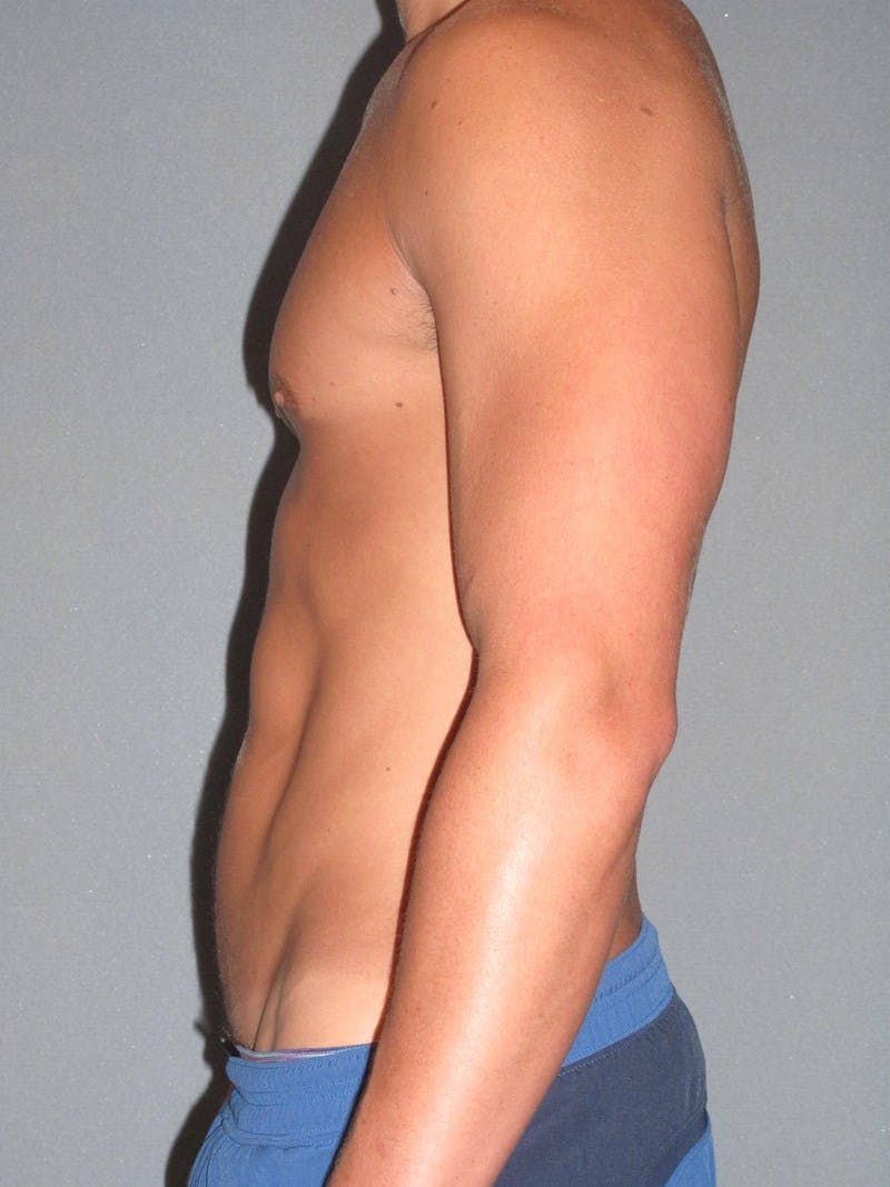 Abdominal Etching Before & After Gallery - Patient 20913141 - Image 6