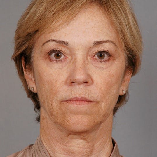 Facelift Before & After Gallery - Patient 20938834 - Image 1
