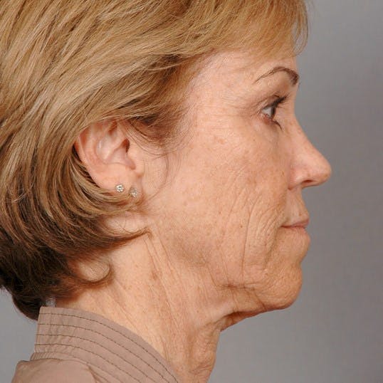 Facelift Before & After Gallery - Patient 20938834 - Image 5