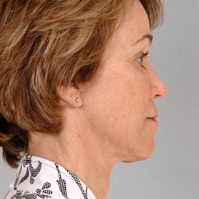 Facelift Before & After Gallery - Patient 20938834 - Image 6