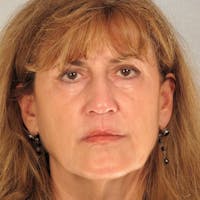 Facelift Before & After Gallery - Patient 20938835 - Image 1