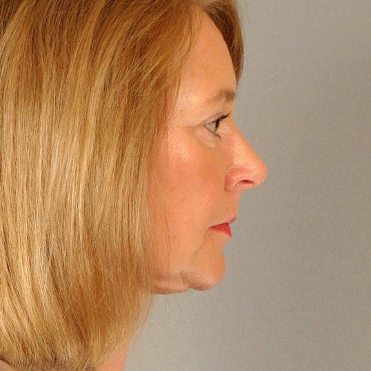 Facelift Before & After Gallery - Patient 20938836 - Image 6