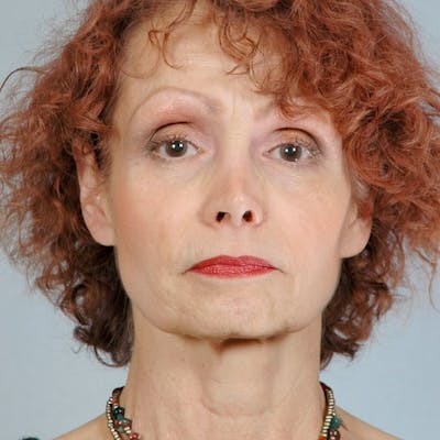 Facelift Before & After Gallery - Patient 20939365 - Image 1