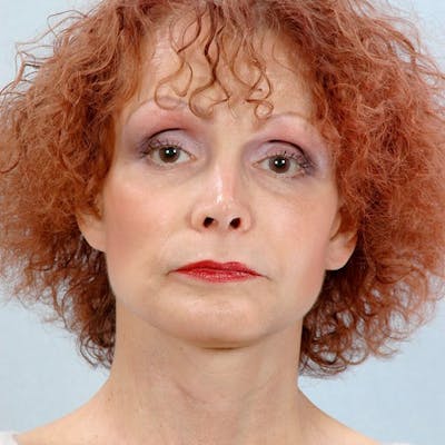 Facelift Before & After Gallery - Patient 20939365 - Image 2