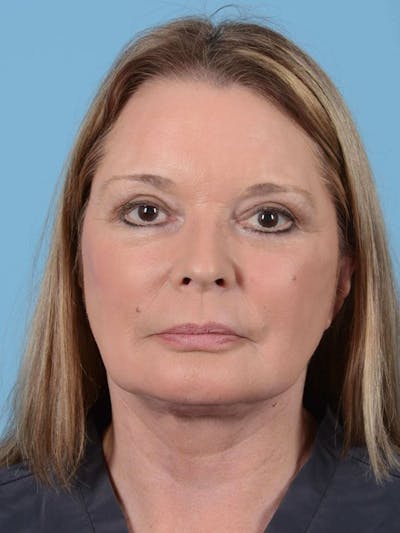 Facelift Before & After Gallery - Patient 20906605 - Image 2