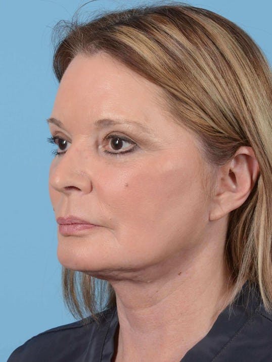 Facelift Before & After Gallery - Patient 20906605 - Image 4