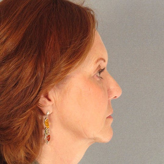 Neck Lift Before & After Gallery - Patient 20953766 - Image 5