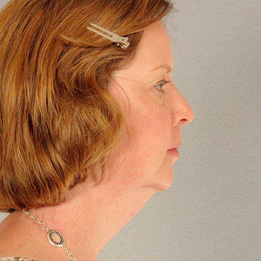 Neck Lift Before & After Gallery - Patient 20953769 - Image 5