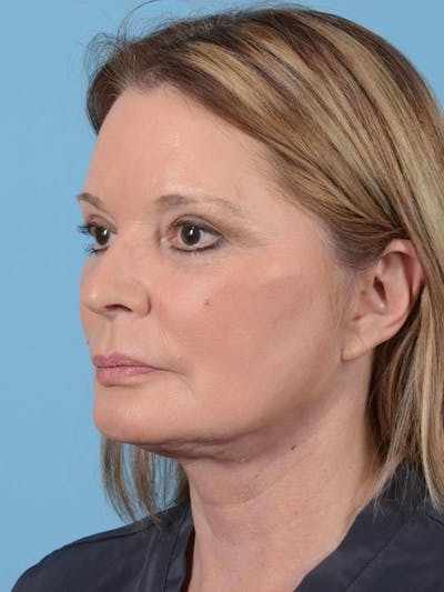 Neck Lift Before & After Gallery - Patient 20954011 - Image 4