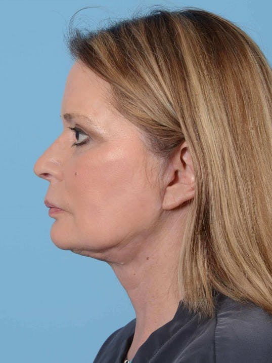 Neck Lift Before & After Gallery - Patient 20954011 - Image 6