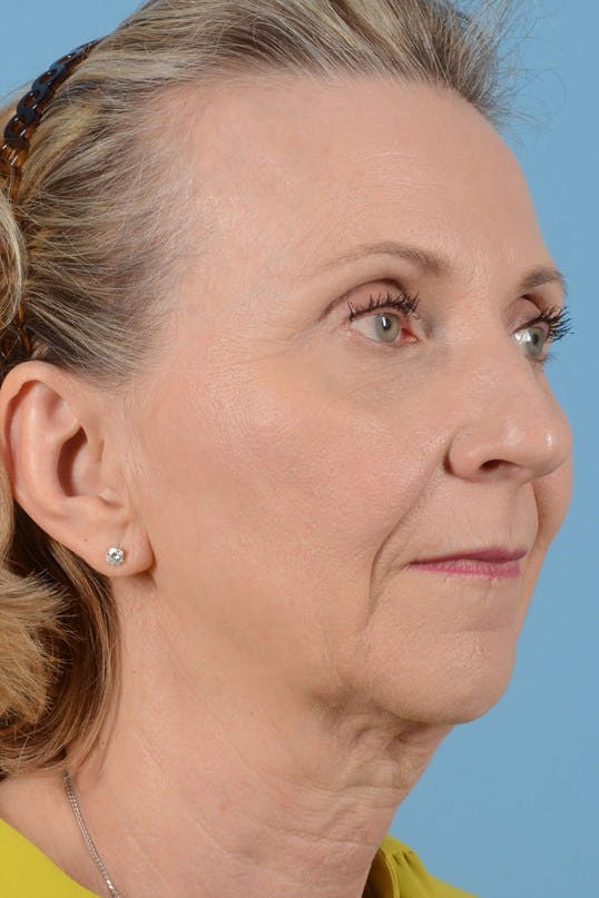 Neck Lift Before & After Gallery - Patient 20954014 - Image 1