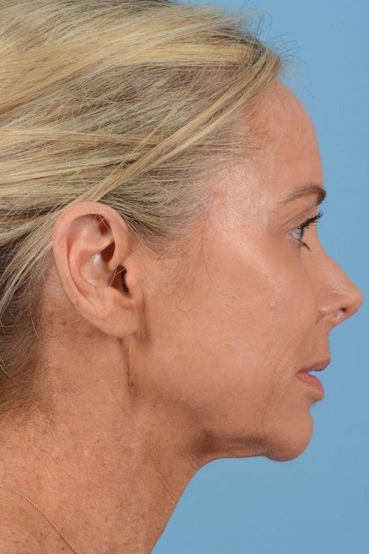 Neck Lift Before & After Gallery - Patient 20954016 - Image 5
