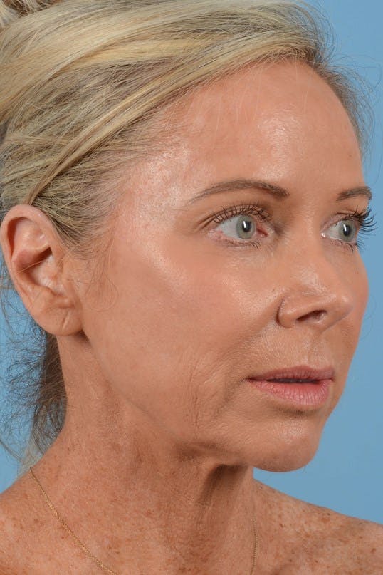 Neck Lift Before & After Gallery - Patient 20954016 - Image 1