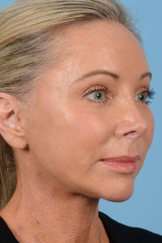 Neck Lift Before & After Gallery - Patient 20954016 - Image 2