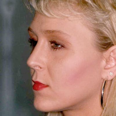 Rhinoplasty Before & After Gallery - Patient 20968411 - Image 2