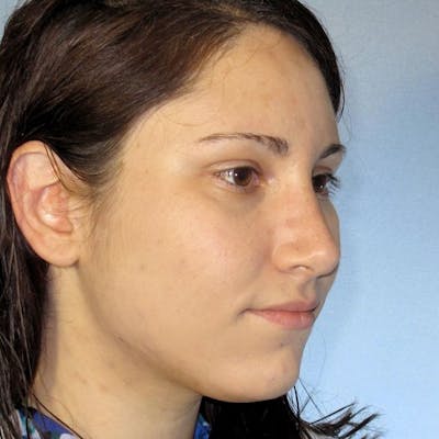 Rhinoplasty Before & After Gallery - Patient 20968412 - Image 6