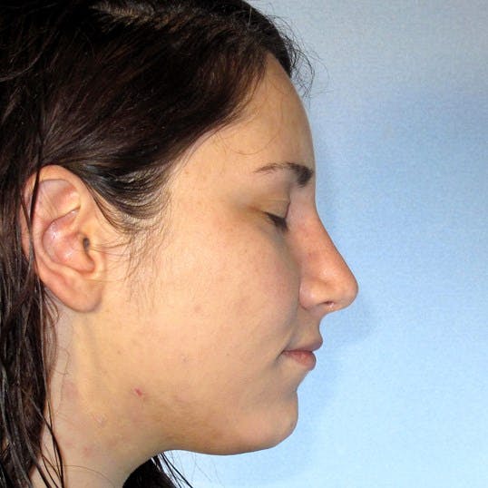 Rhinoplasty Before & After Gallery - Patient 20968412 - Image 2