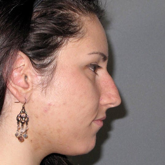 Rhinoplasty Before & After Gallery - Patient 20968412 - Image 1