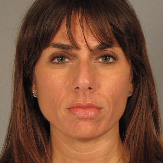 Rhinoplasty Before & After Gallery - Patient 20968413 - Image 3