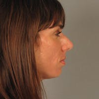 Rhinoplasty Before & After Gallery - Patient 20968413 - Image 1