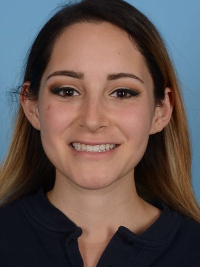 Rhinoplasty Before & After Gallery - Patient 20968414 - Image 4