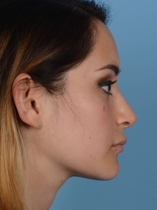 Rhinoplasty Before & After Gallery - Patient 20968414 - Image 2
