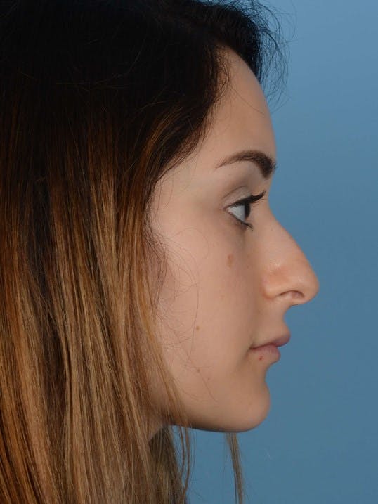 Rhinoplasty Before & After Gallery - Patient 20968414 - Image 1