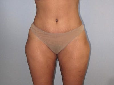Liposuction Before & After Gallery - Patient 20909818 - Image 2