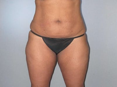 Tummy Tuck Before & After Gallery - Patient 20909847 - Image 1