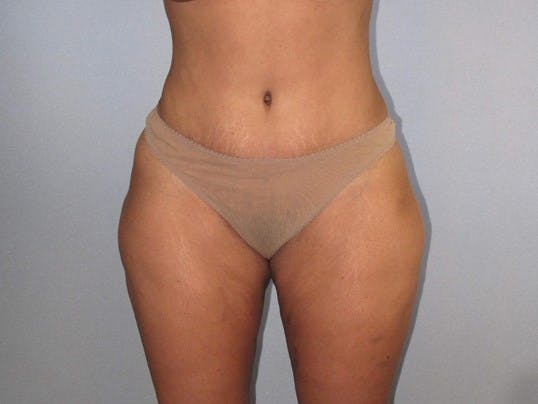 Tummy Tuck Before & After Gallery - Patient 20909847 - Image 2