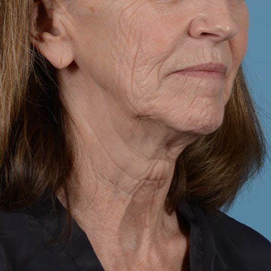 Neck Lift Before & After Gallery - Patient 26805854 - Image 11