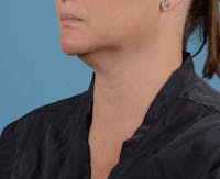 Liposuction Before & After Gallery - Patient 26815743 - Image 1