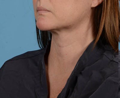 Liposuction Before & After Gallery - Patient 26815743 - Image 2