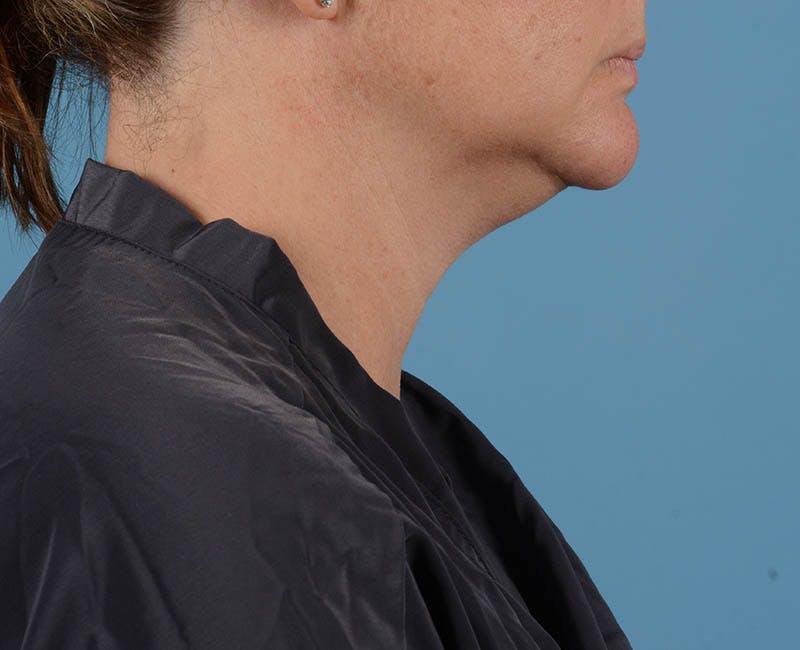 Liposuction Before & After Gallery - Patient 26815743 - Image 3