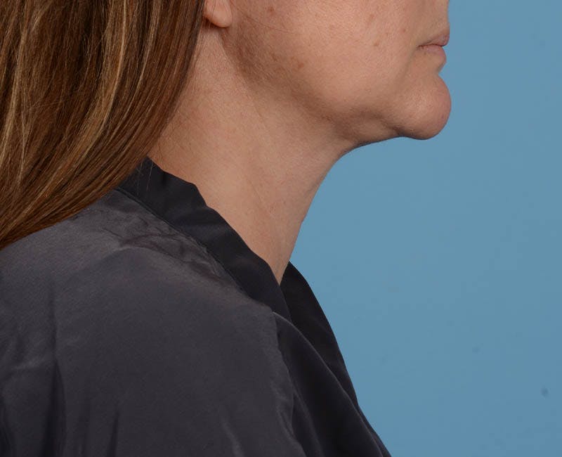 Liposuction Before & After Gallery - Patient 26815743 - Image 4