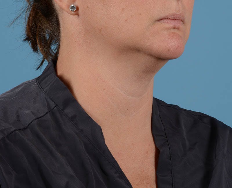 Liposuction Before & After Gallery - Patient 26815743 - Image 5