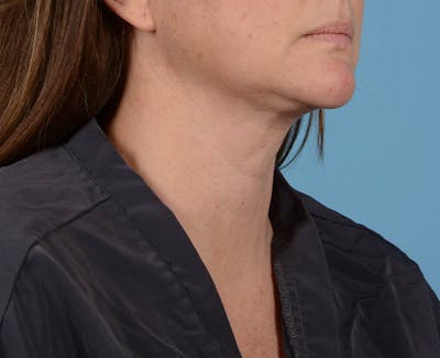 Liposuction Before & After Gallery - Patient 26815743 - Image 6