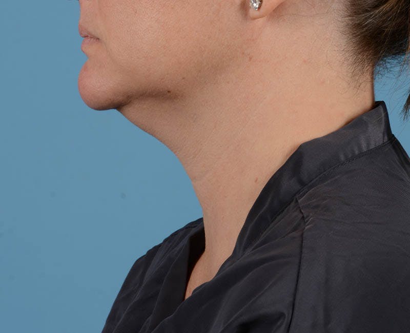Liposuction Before & After Gallery - Patient 26815743 - Image 7