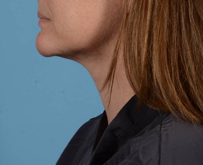 Liposuction Before & After Gallery - Patient 26815743 - Image 8