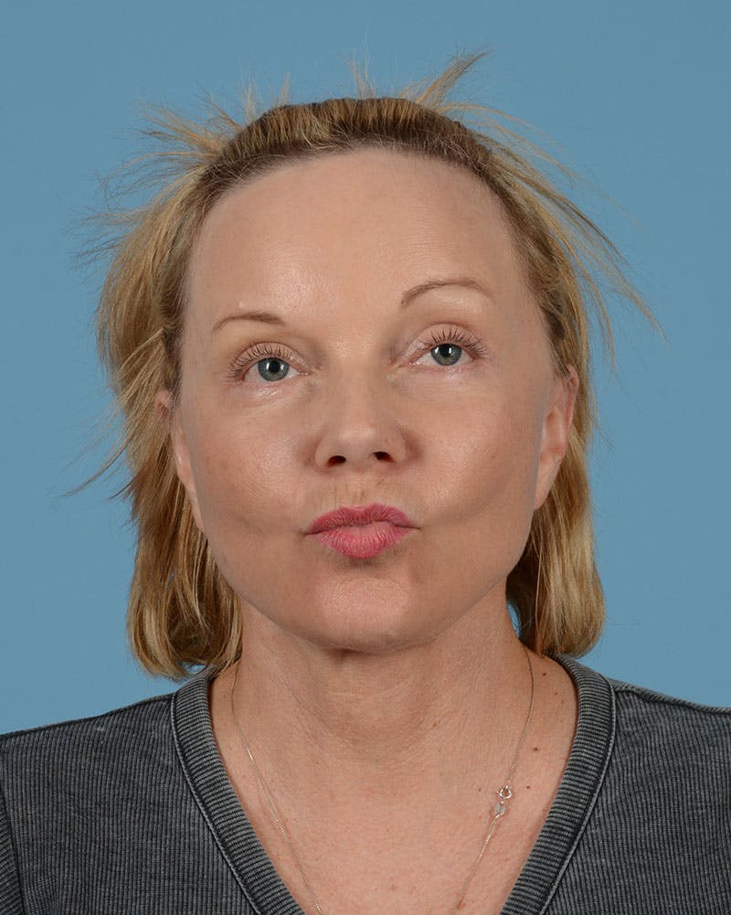 Facelift Before & After Gallery - Patient 33747857 - Image 4