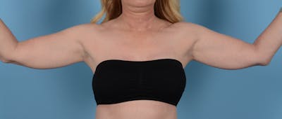 Liposuction Before & After Gallery - Patient 33798956 - Image 1