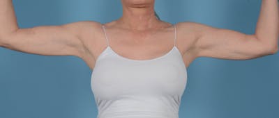 Liposuction Before & After Gallery - Patient 33798956 - Image 2