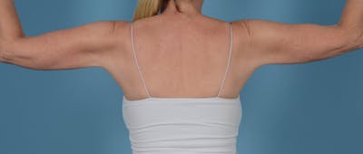 Liposuction Before & After Gallery - Patient 33798956 - Image 6