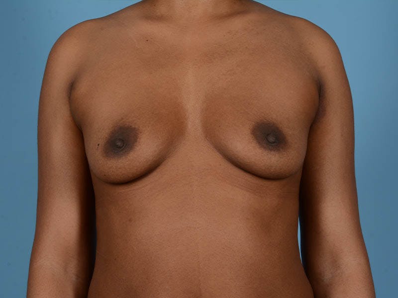 Breast Augmentation Gallery - Patient 33817475 - Image 1
