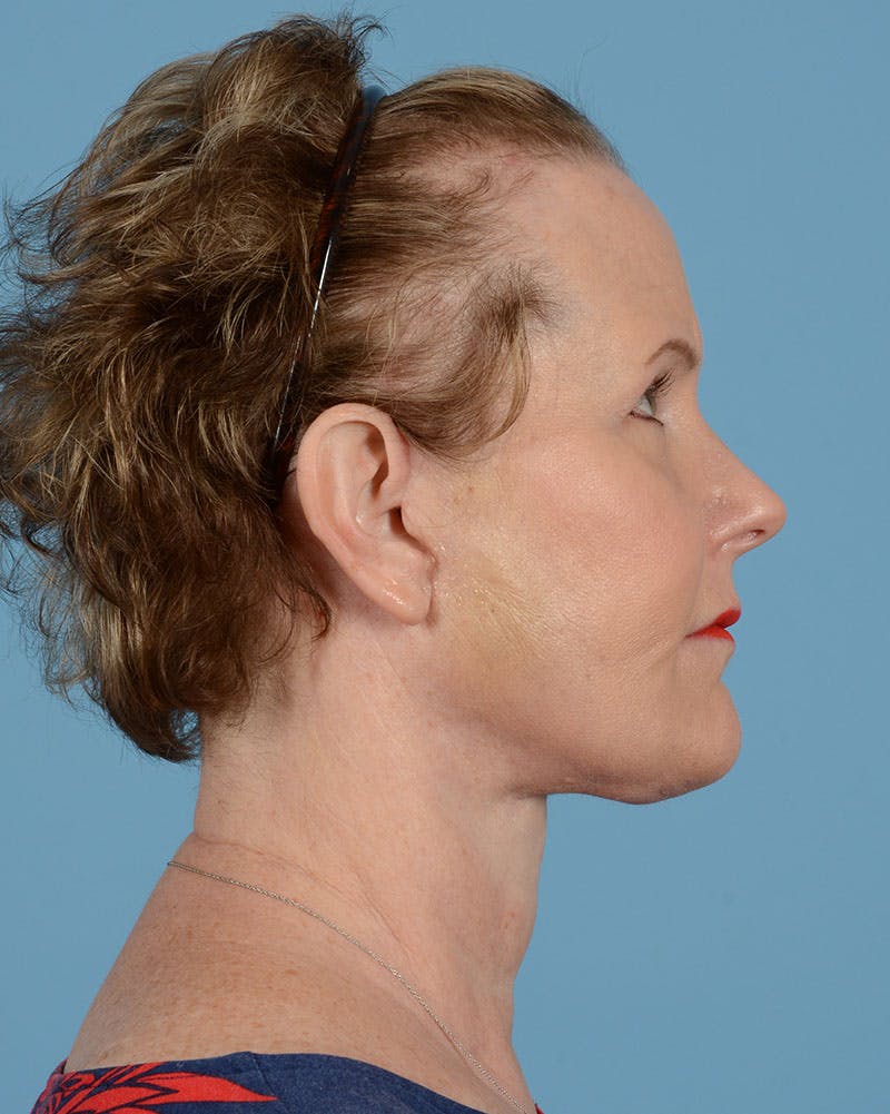 Facelift Before & After Gallery - Patient 39173697 - Image 6