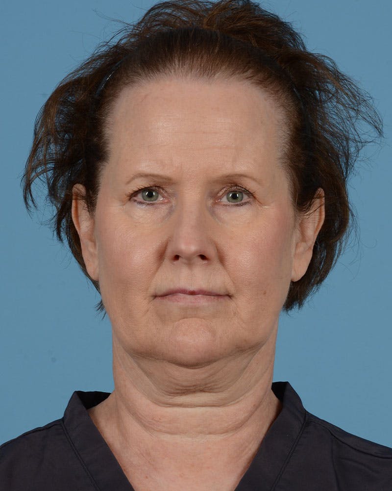 Neck Lift Before & After Gallery - Patient 39182691 - Image 1