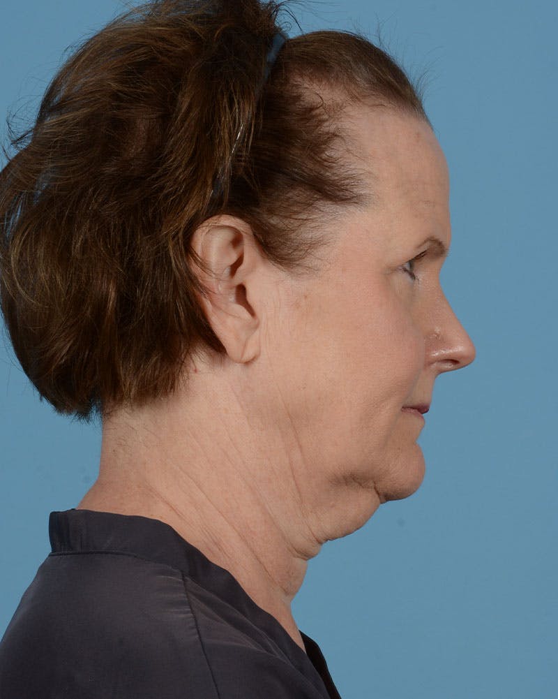 Neck Lift Before & After Gallery - Patient 39182691 - Image 5