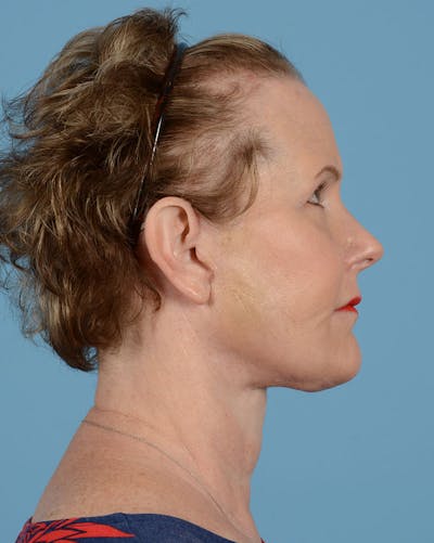 Neck Lift Before & After Gallery - Patient 39182691 - Image 6
